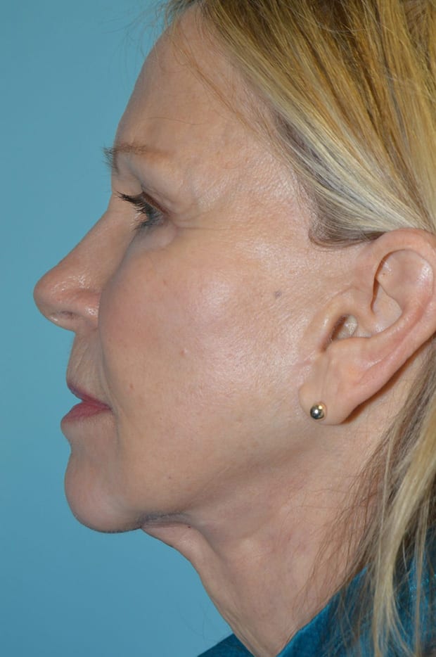 Microlift Patient Photo - Case 5230 - after view-2