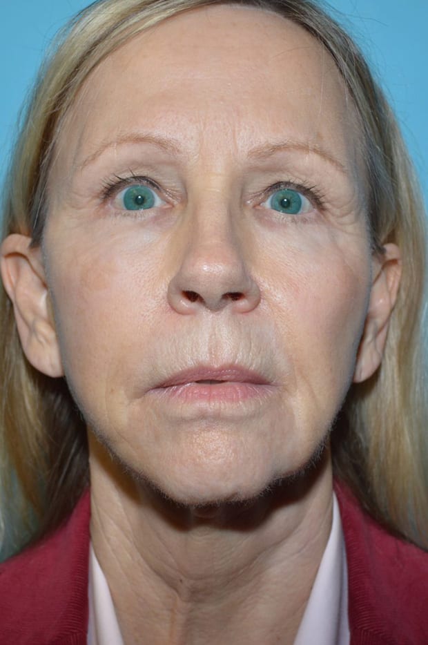 Microlift Patient Photo - Case 5230 - before view-0
