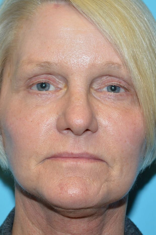 Lower Eyelid Lift/Pinch Patient Photo - Case 5239 - after view