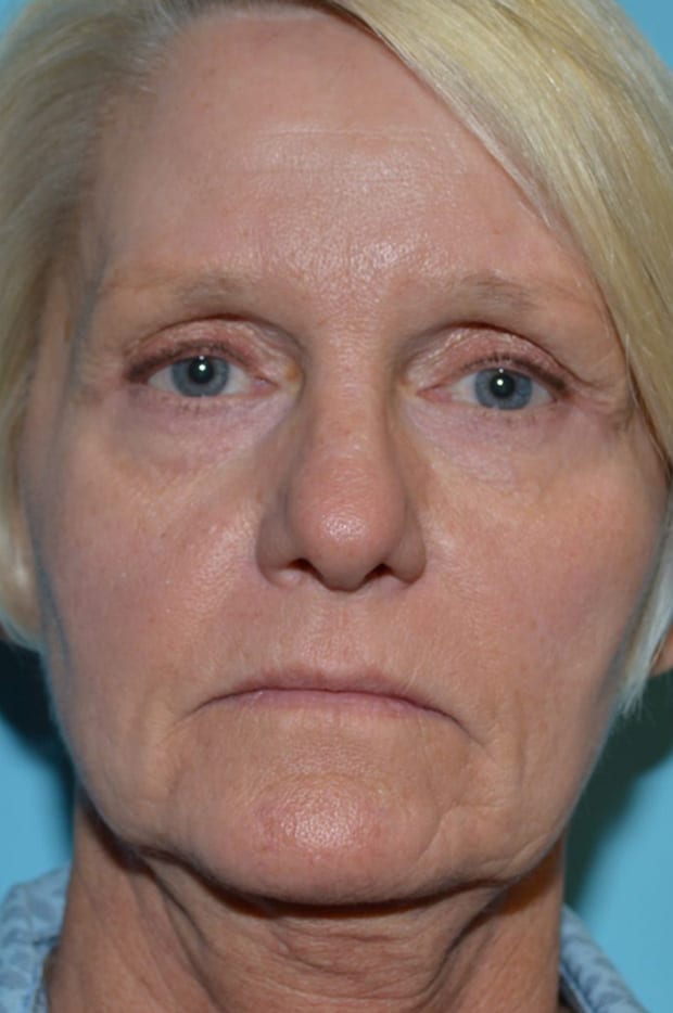 Lower Eyelid Lift/Pinch Patient Photo - Case 5239 - before view-0