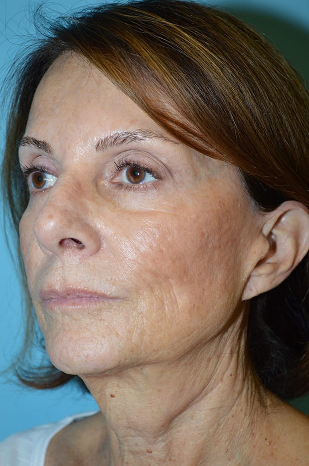 Microlift Patient Photo - Case 5254 - before view-1