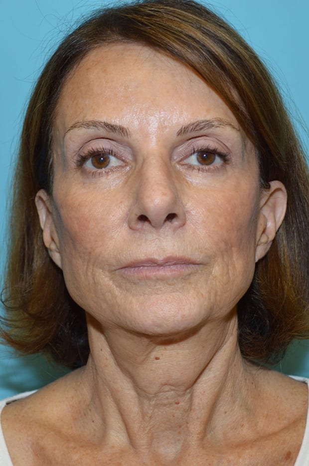 Microlift Patient Photo - Case 5254 - before view-