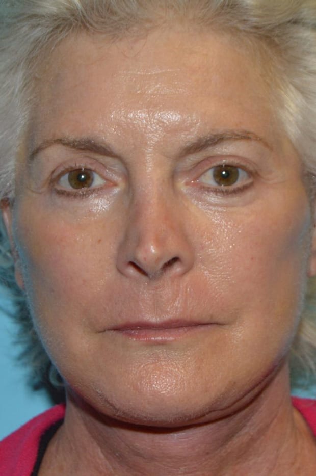 Microlift Patient Photo - Case 5263 - after view-1