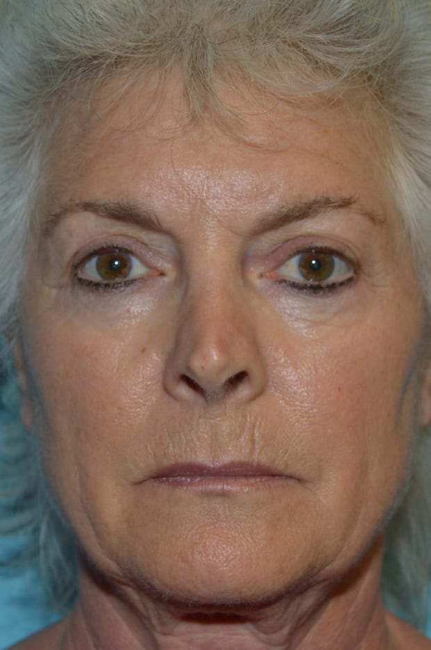 Microlift Patient Photo - Case 5263 - before view-1