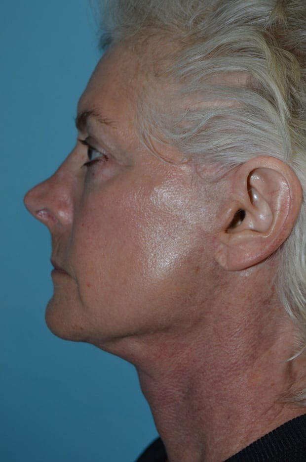Microlift Patient Photo - Case 5263 - before view-4