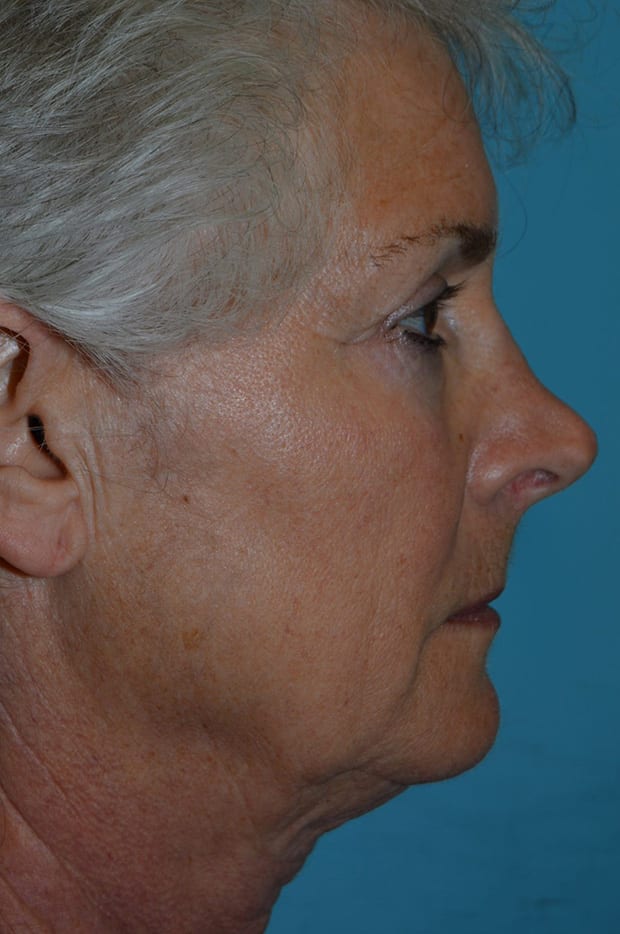 Microlift Patient Photo - Case 5263 - before view-5