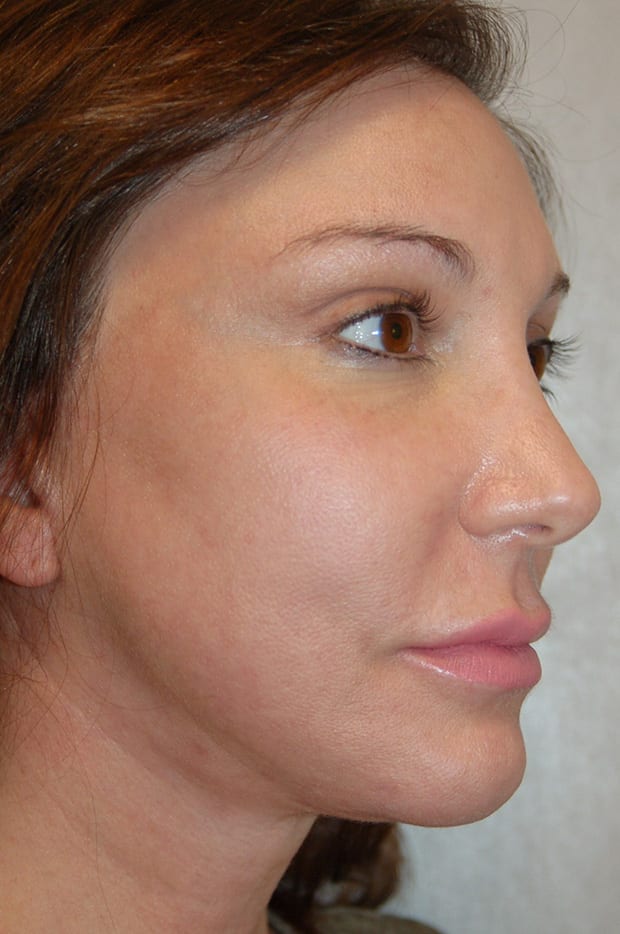 Forehead Lift Patient Photo - Case 5278 - after view