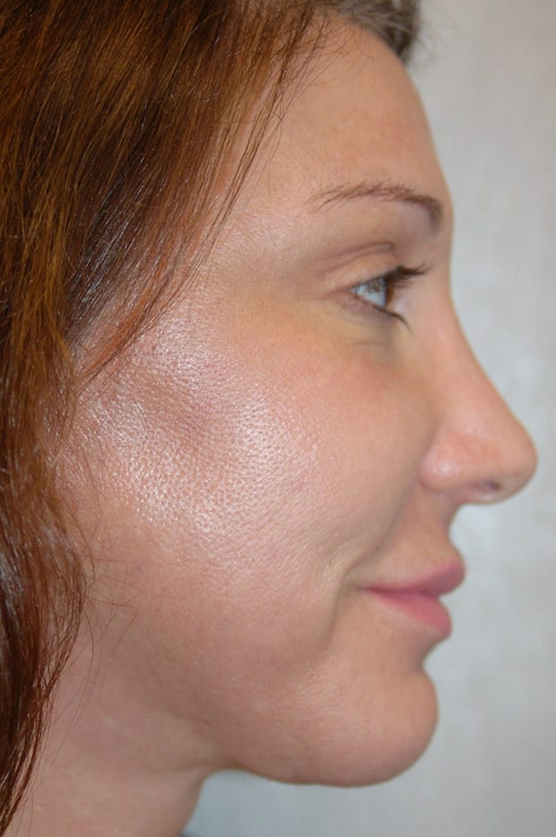 Forehead Lift Patient Photo - Case 5278 - after view-1