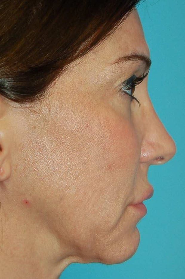 Forehead Lift Patient Photo - Case 5278 - before view-1