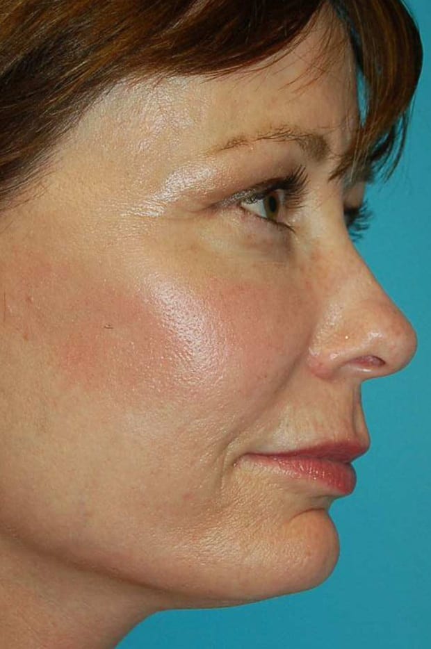 Microlift Patient Photo - Case 5286 - before view-1
