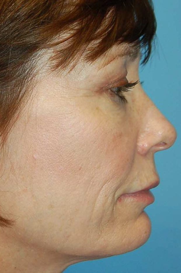 Microlift Patient Photo - Case 5286 - after view-1