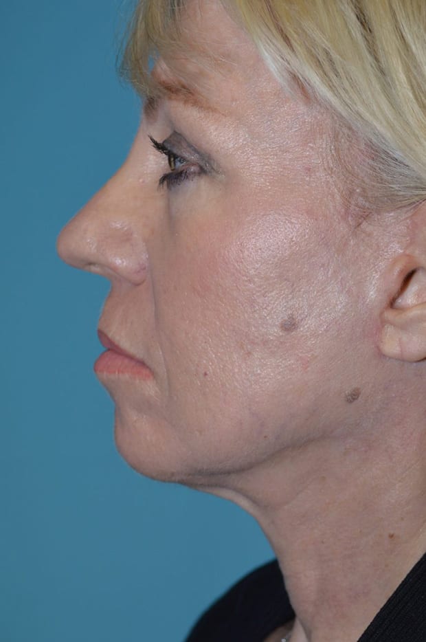 Microlift Patient Photo - Case 5293 - after view-3
