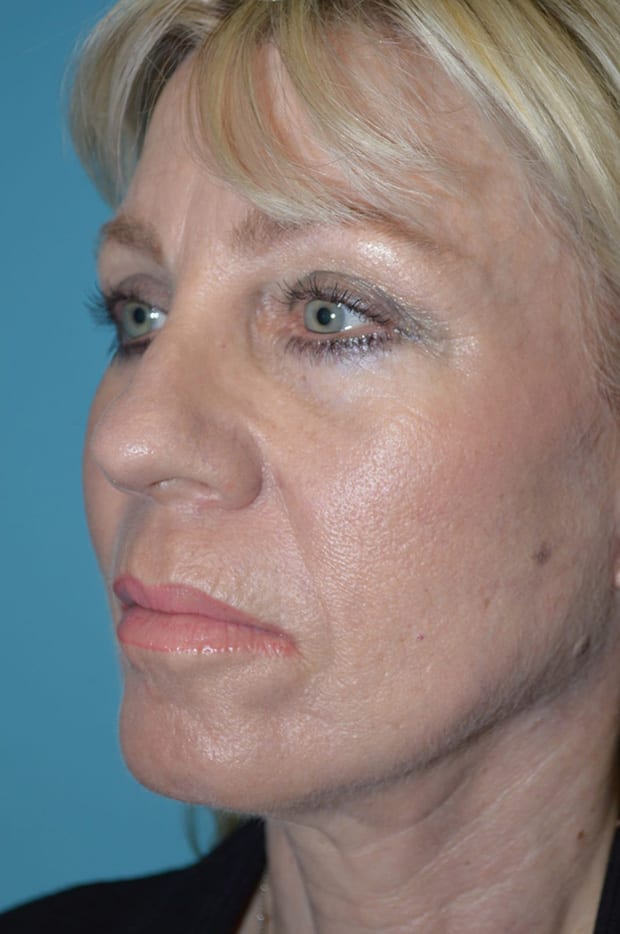 Microlift Patient Photo - Case 5293 - after view-1