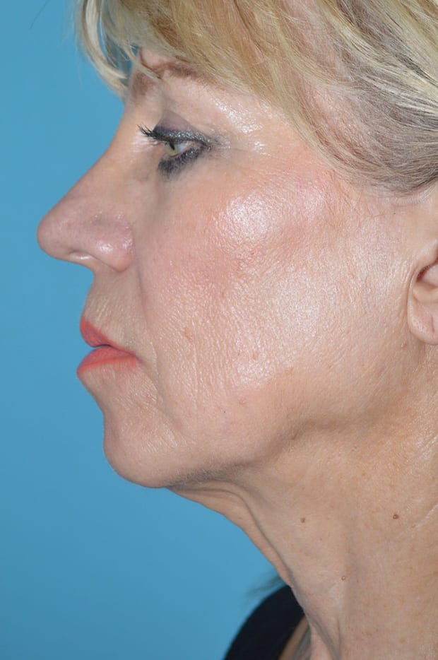 Microlift Patient Photo - Case 5293 - before view-2