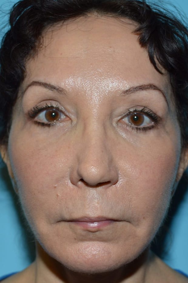 Microlift Patient Photo - Case 5302 - after view-0