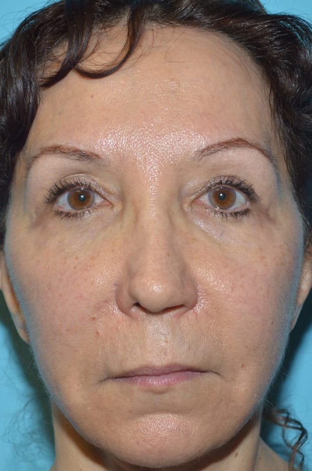 Microlift Patient Photo - Case 5302 - before view-