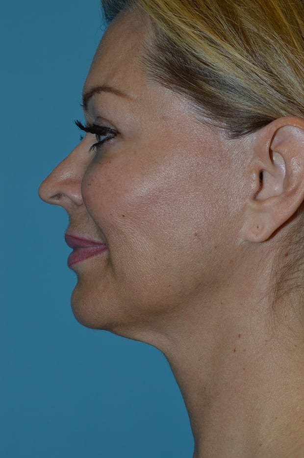 Forehead Lift Patient Photo - Case 5307 - before view-1