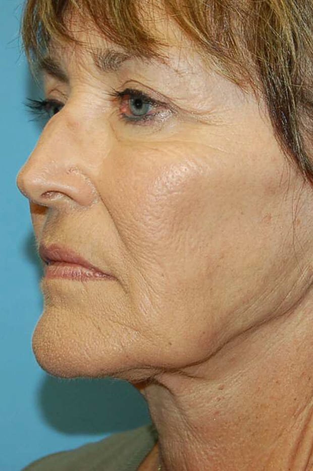 Microlift Patient Photo - Case 5327 - before view-1