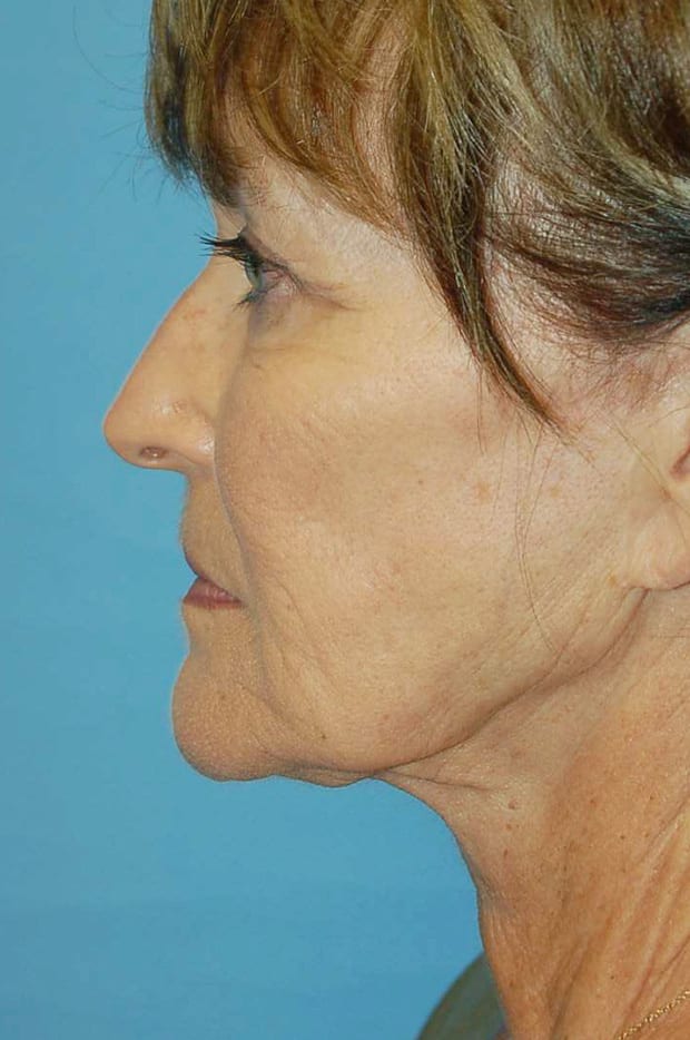 Microlift Patient Photo - Case 5327 - before view-2