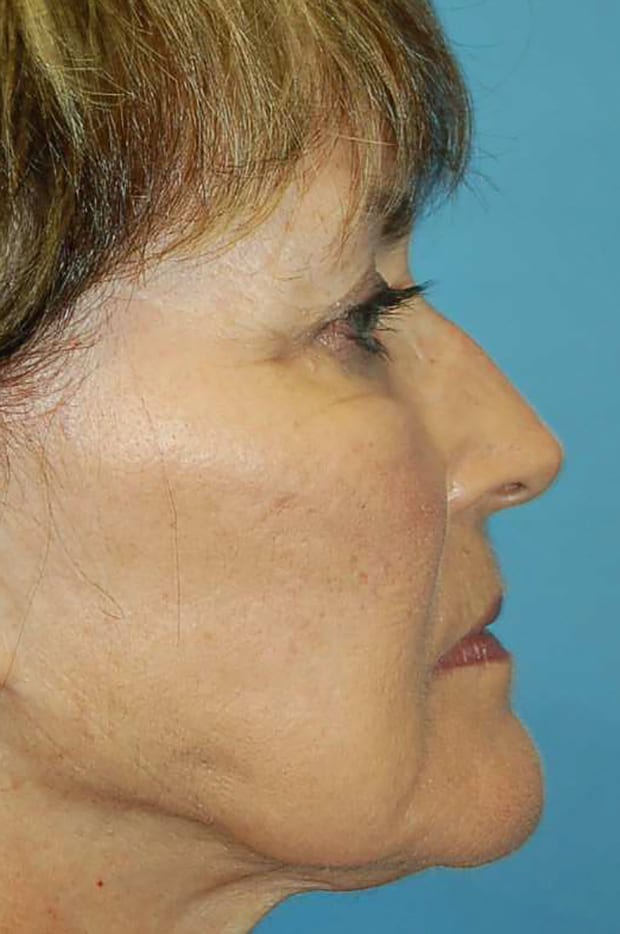Microlift Patient Photo - Case 5327 - before view-4