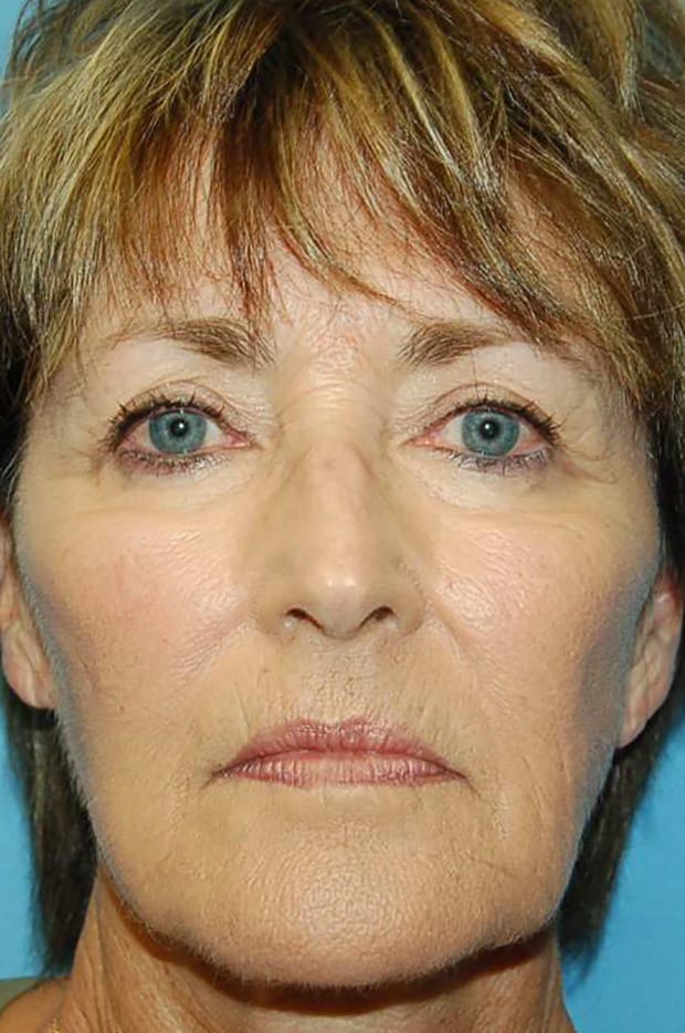 Microlift Patient Photo - Case 5327 - before view-
