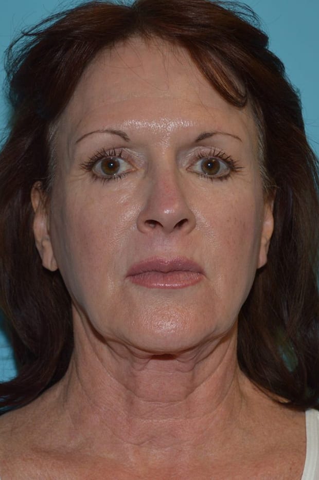 Forehead Lift Patient Photo - Case 5338 - before view-0