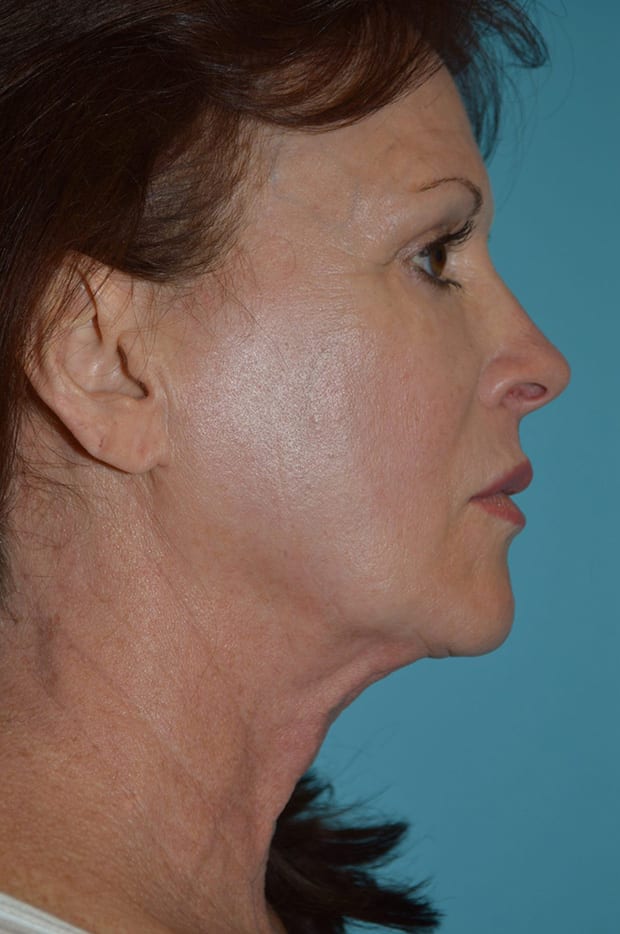 Forehead Lift Patient Photo - Case 5338 - before view-1