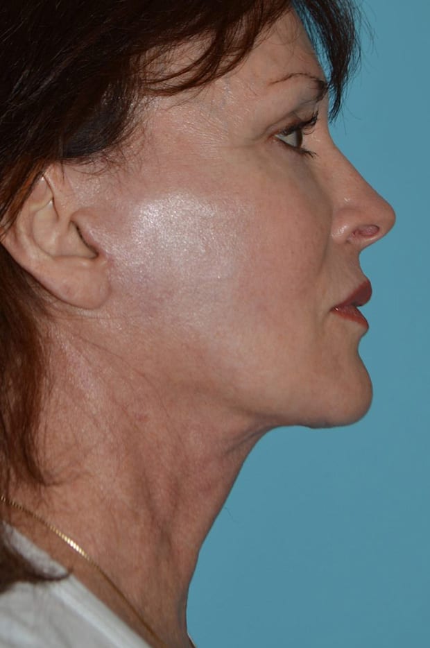 Forehead Lift Patient Photo - Case 5338 - after view-1