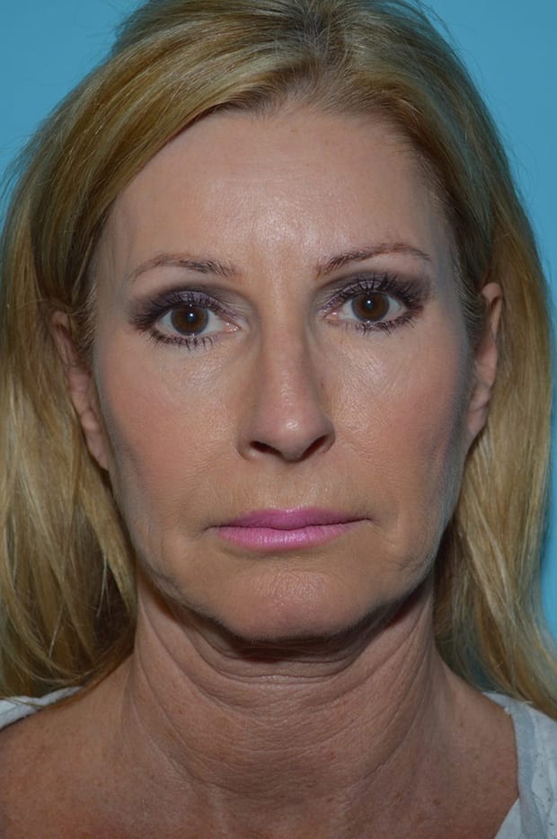 Microlift Patient Photo - Case 5343 - before view-