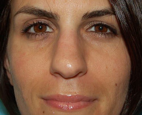 Rhinoplasty Patient Photo - Case 5346 - before view-0