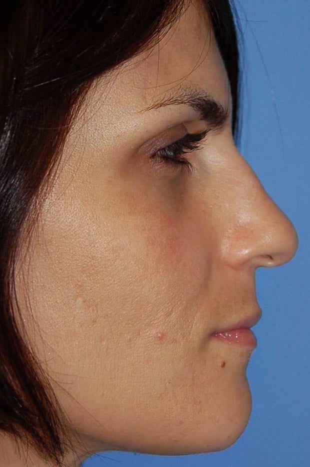 Rhinoplasty Patient Photo - Case 5346 - before view-1