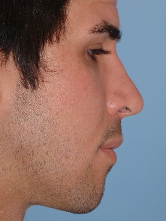 Rhinoplasty Patient Photo - Case 5351 – Click Photos for More - after view-1