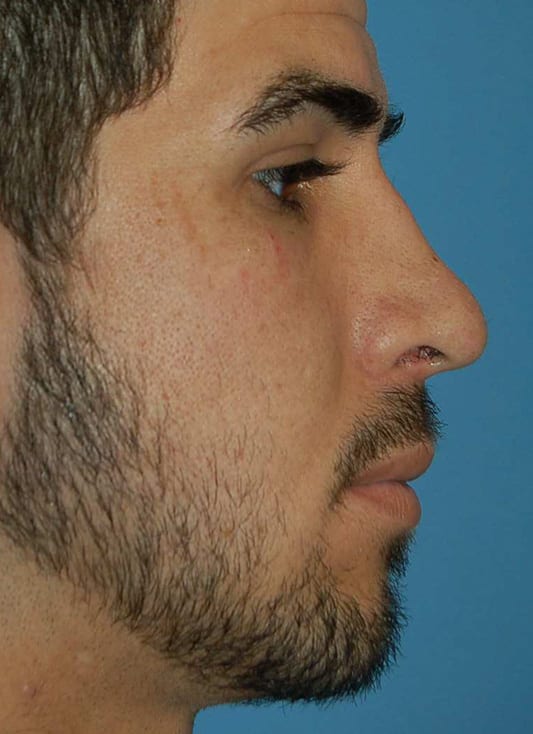 Rhinoplasty Patient Photo - Case 5351 - before view-1