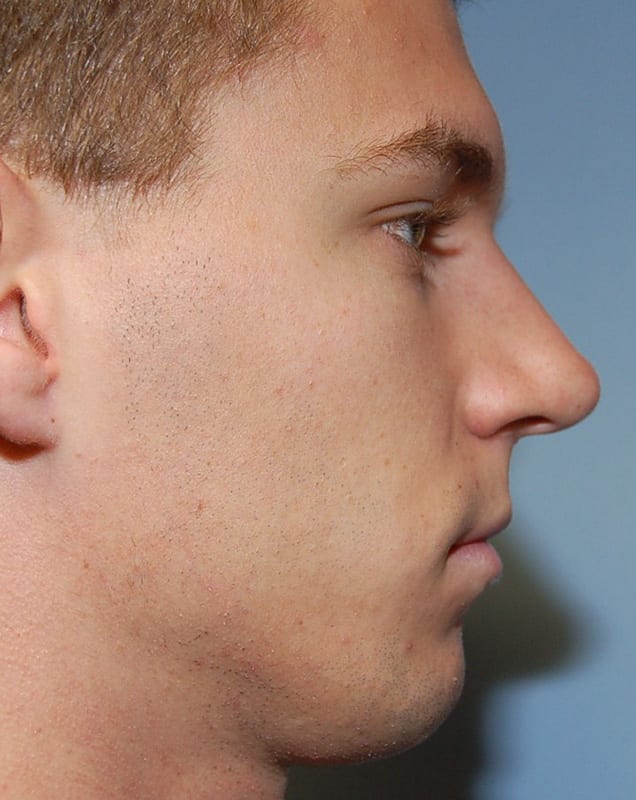 Rhinoplasty Patient Photo - Case 5361 - after view-0