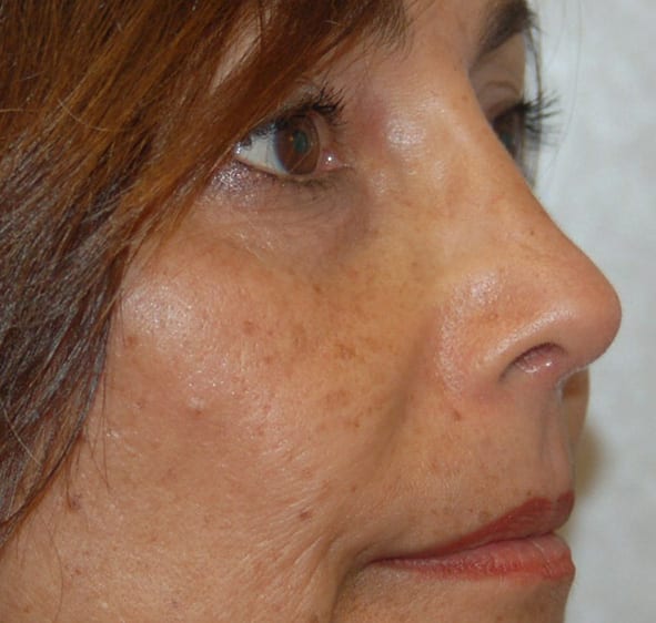 Rhinoplasty Patient Photo - Case 5364 - after view-1