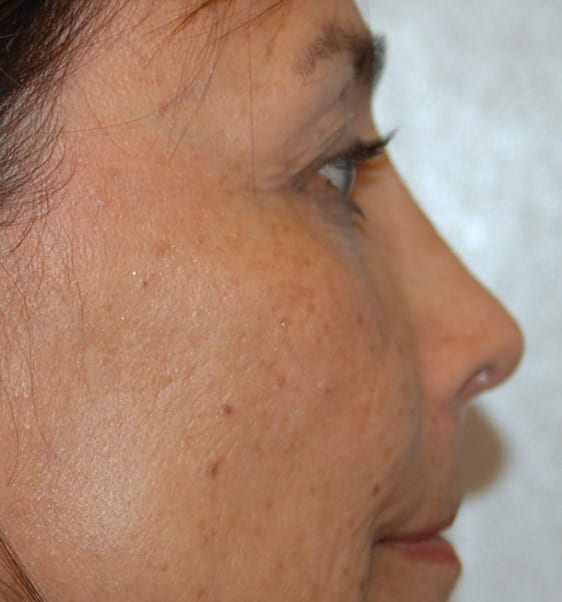 Rhinoplasty Patient Photo - Case 5364 – Click Photos for More - after view-0