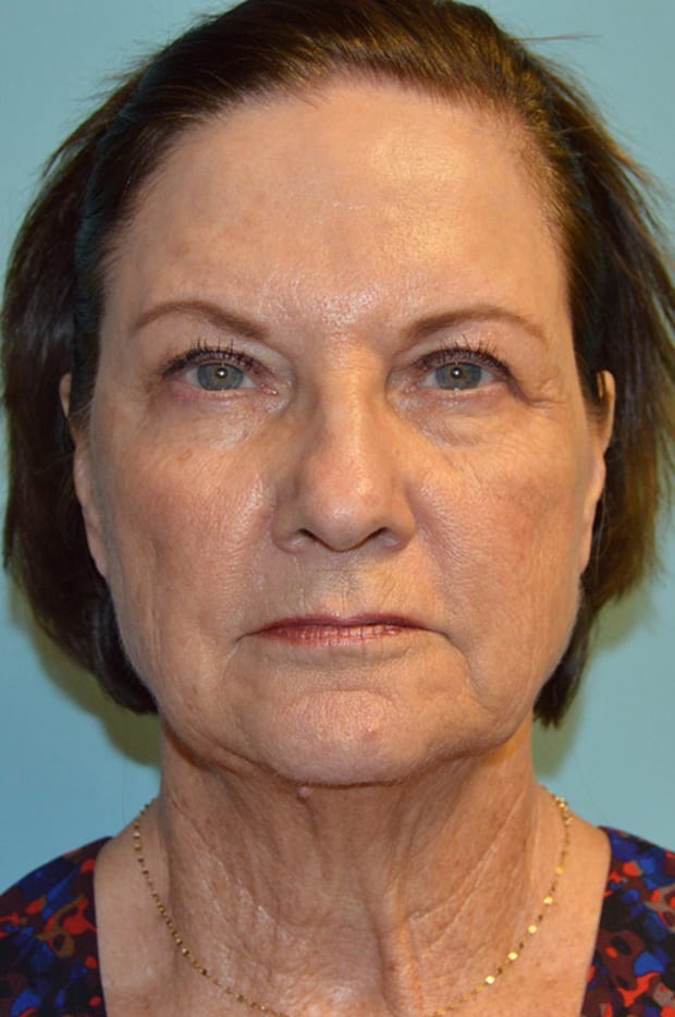 Eyelid Surgery Patient Photo - Case 5369 - before view-