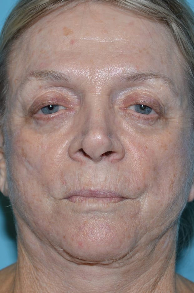 Eyelid Surgery Patient Photo - Case 5376 - before view-1