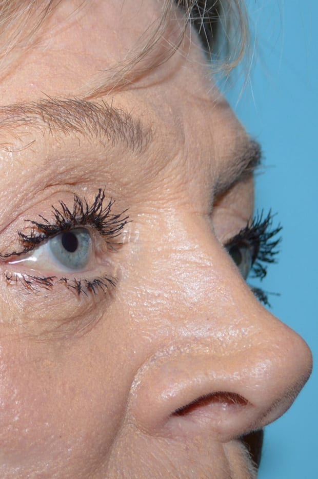 Eyelid Surgery Patient Photo - Case 5376 - after view-3