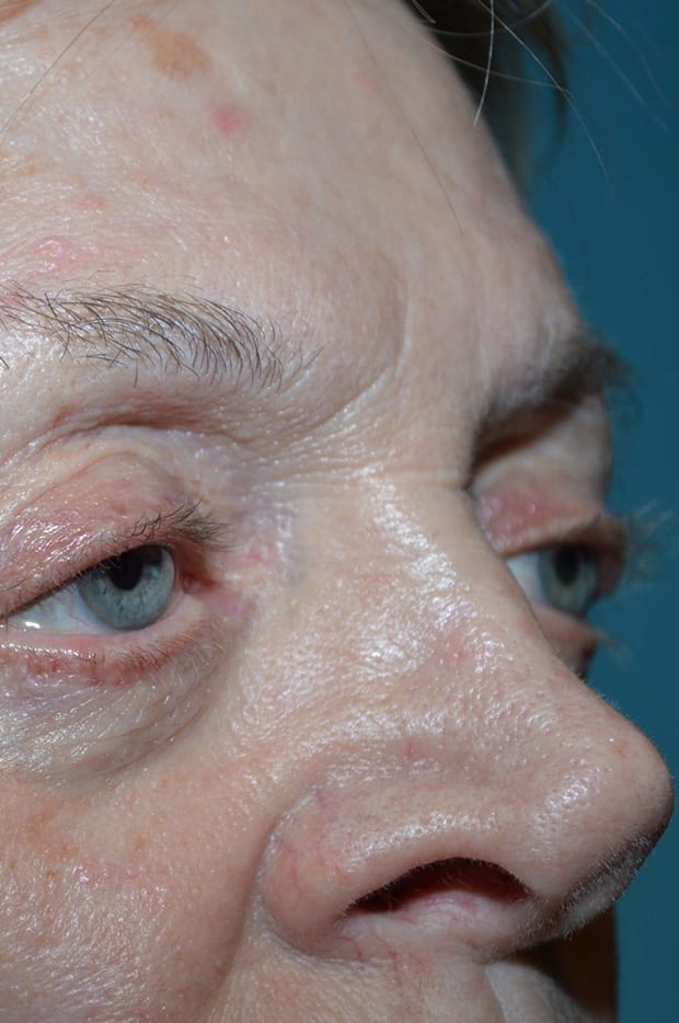 Eyelid Surgery Patient Photo - Case 5376 - before view-3