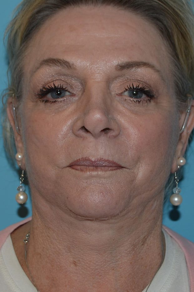 After Eyelid Surgery Aliso Viejo Orange County