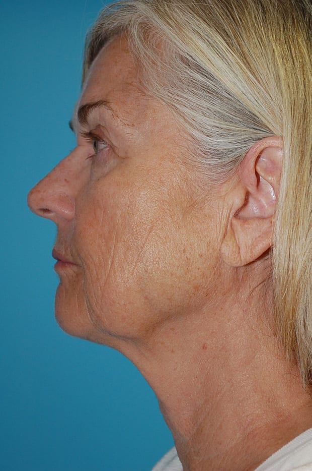 Microlift Patient Photo - Case 5387 - before view-2
