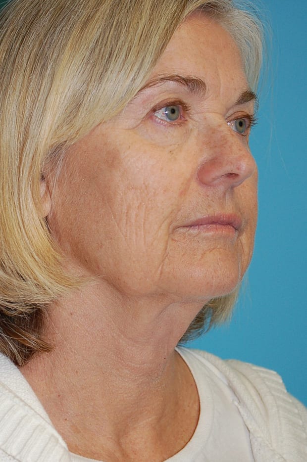 Microlift Patient Photo - Case 5387 - before view-1