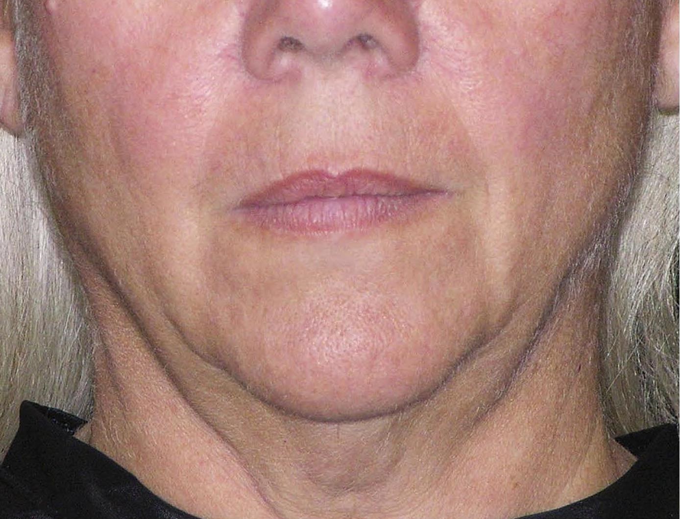 Thermage Patient Photo - Case 5428 - before view-0