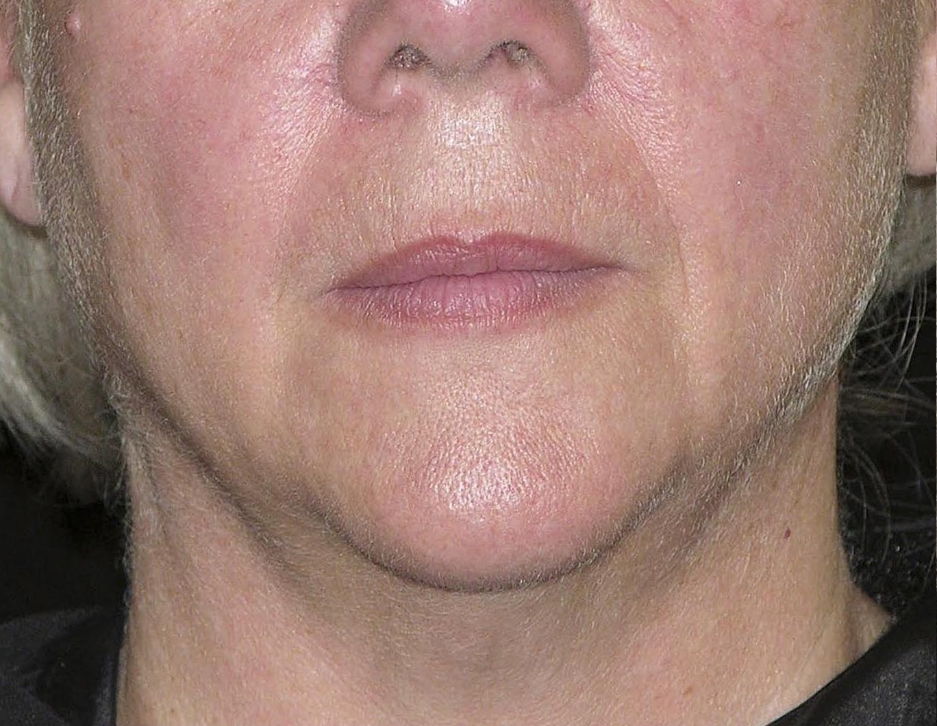 Thermage Patient Photo - Case 5428 - after view-0