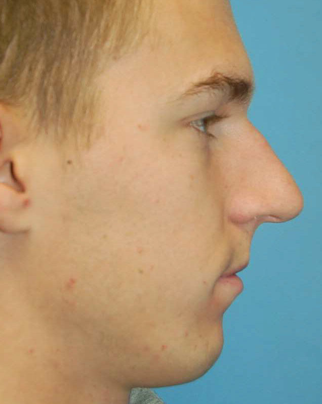 Rhinoplasty Patient Photo - Case 5361 - before view-