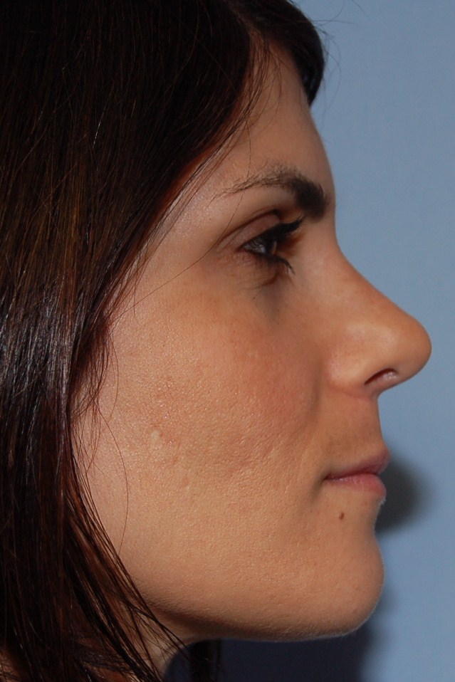 Rhinoplasty Patient Photo - Case 5346 – Click Photos for More - after view-1