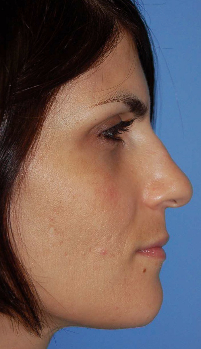 Rhinoplasty Patient Photo - Case 5346 – Click Photos for More - before view-1