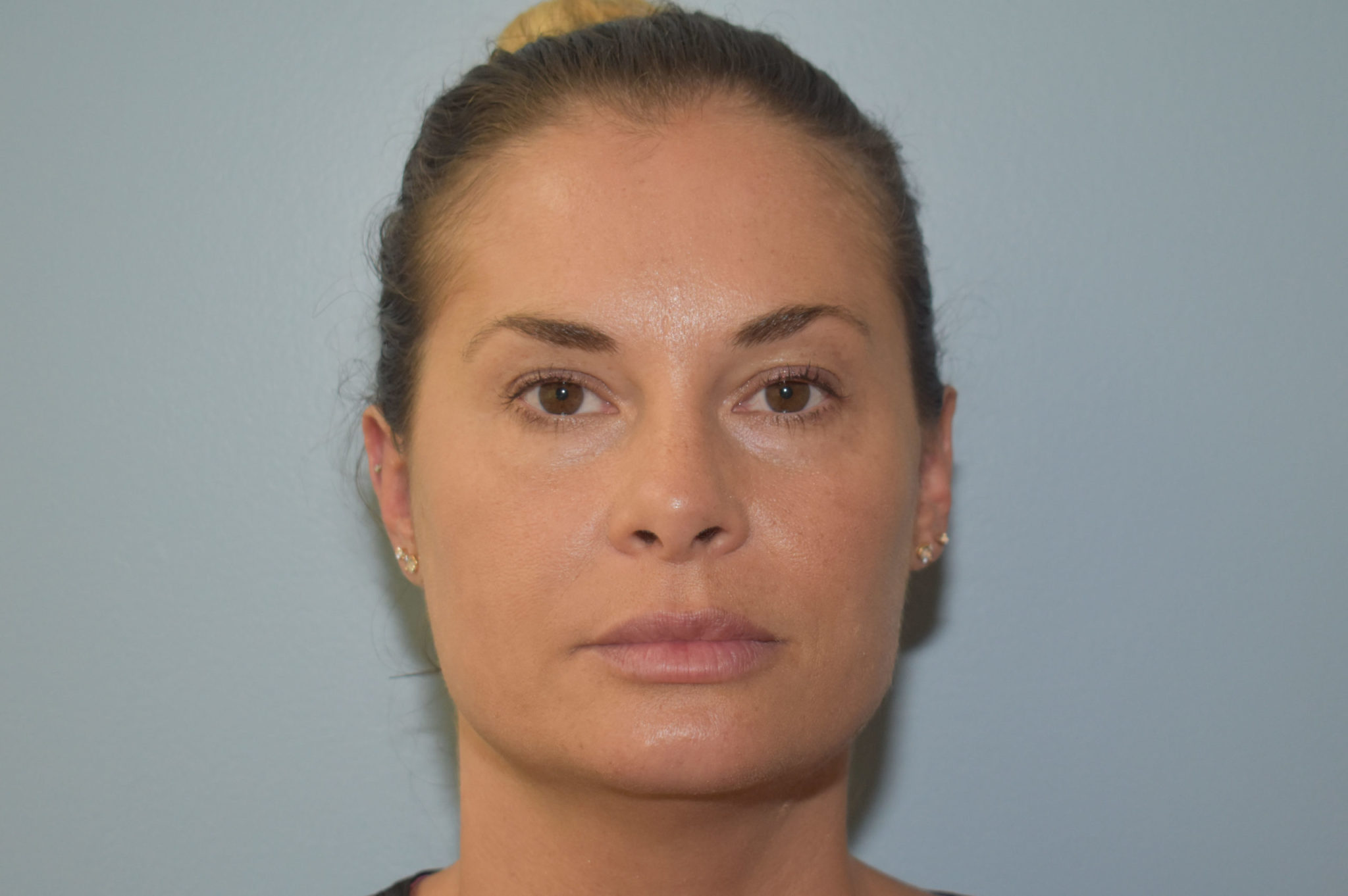 Fillers Patient Photo - Case 5739 - after view-0