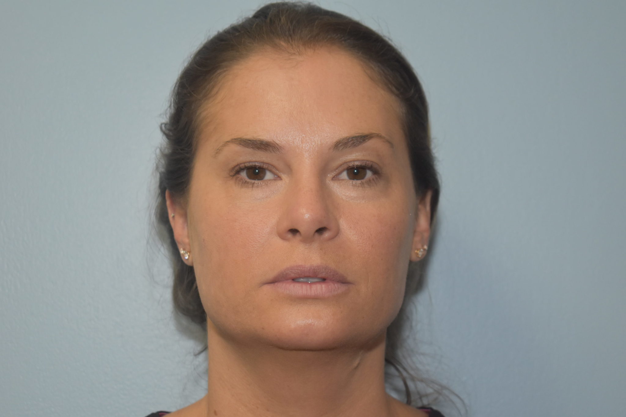 Fillers Patient Photo - Case 5739 - before view-